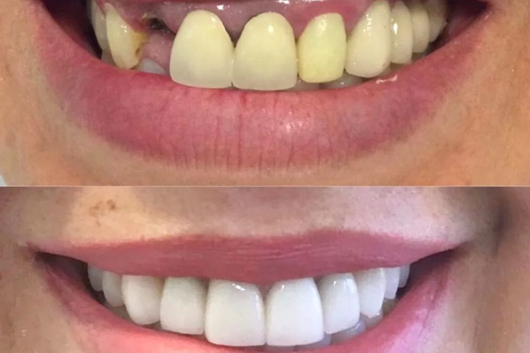 implante-dentario-antes-e-depois01